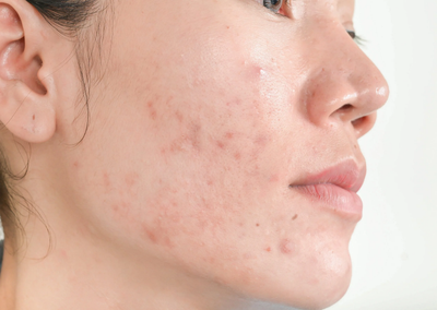 Who Needs Subcision Treatment for Acne Scars the Most Today?