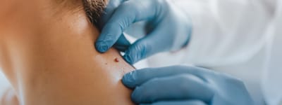 How Long Does Wart Removal Take to Work?
