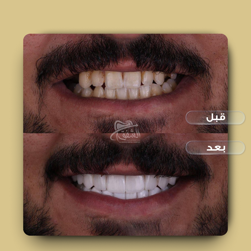 تقويم وتركيبات