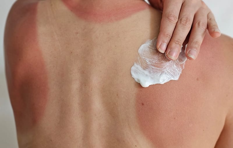 Eczema and Sunburn Relief
