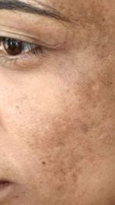 Διαβήτης, Αντίσταση στην Ινσουλίνη & Δέρμα