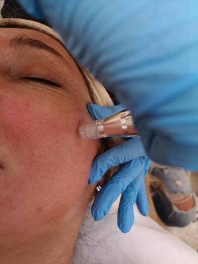 Microneedling: Στοχευμένη Βιοδιέγερση με Ελάχιστο Downtime