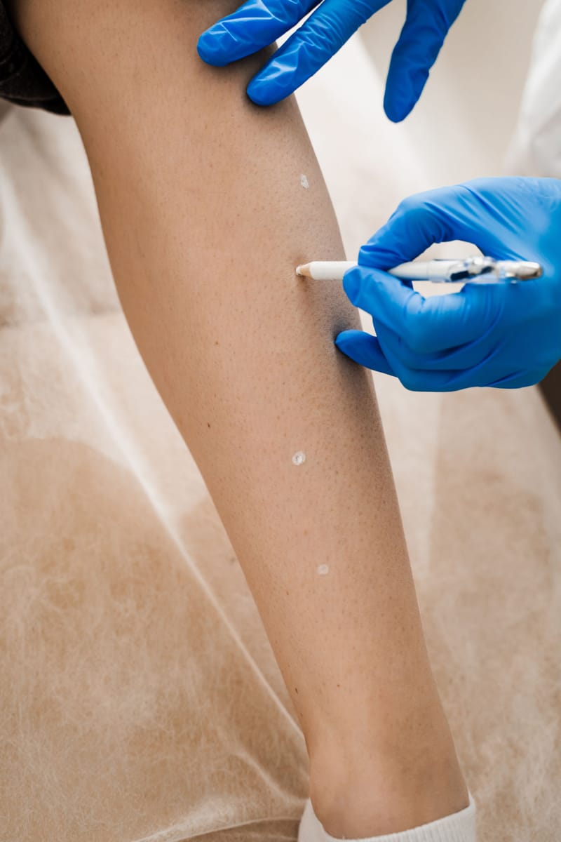 باقة كرايو سبوت – 4 جلسات Cryo Spot Package