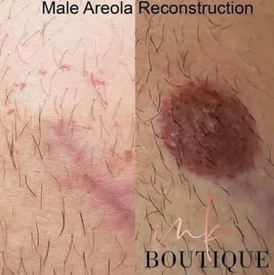 MALE BREAST CANCER AREOLA AND NIPPLE LOSS