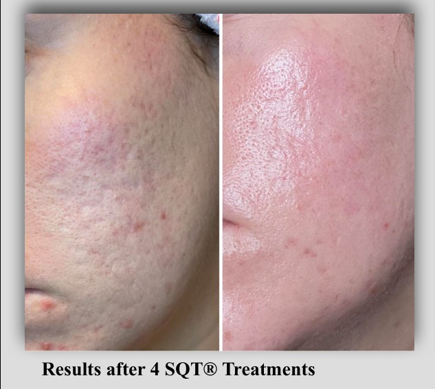 SQT BIO MICRONEEDLING BEFORE/AFTER ACNE PICS