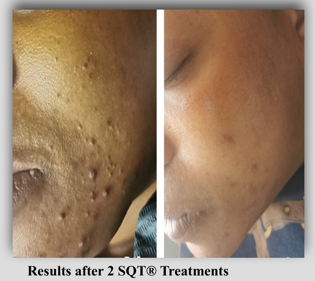 SQT BIO MICRONEEDLING BEFORE/AFTER ACNE PICS