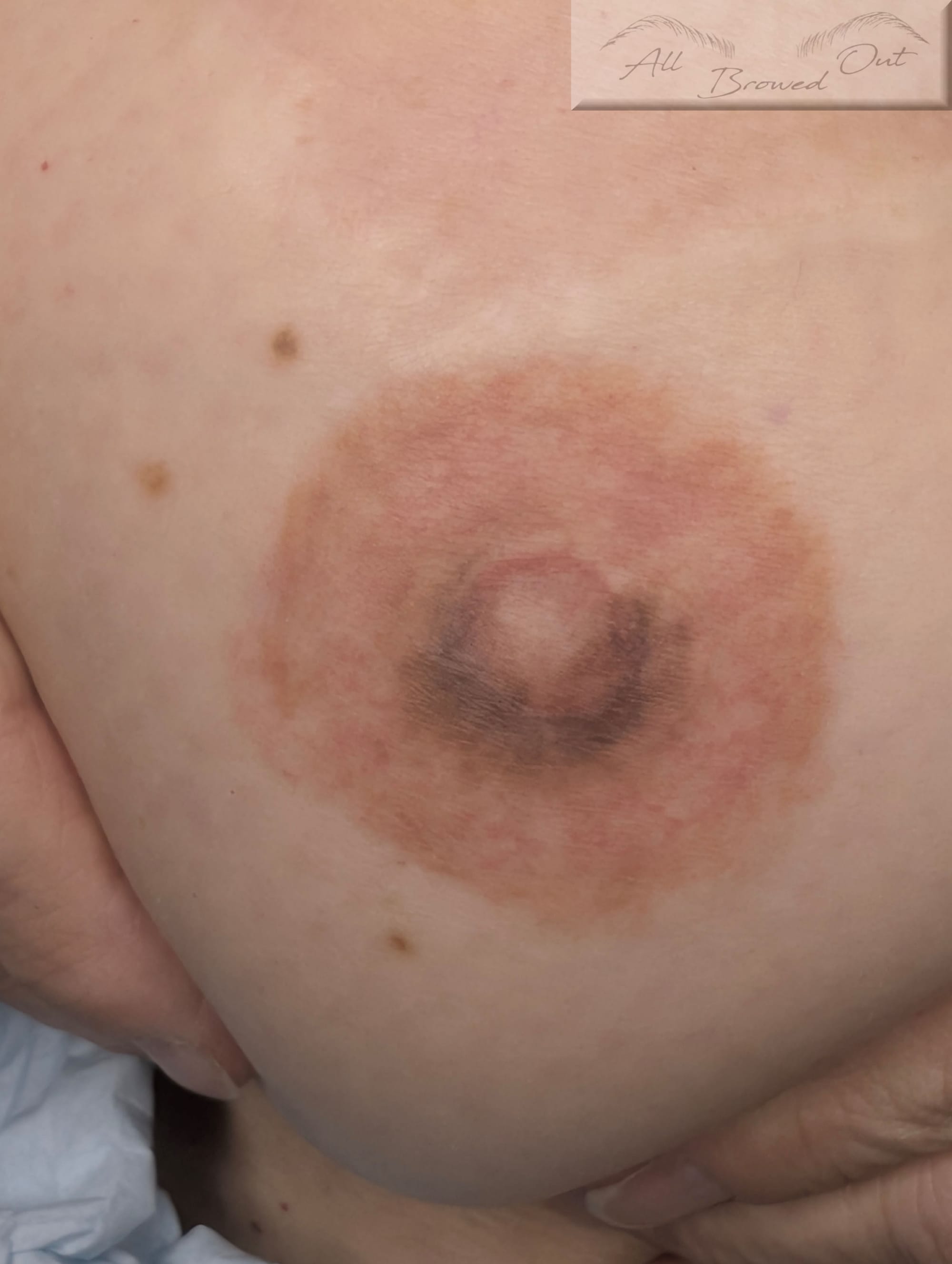 BREAST CANCER SURVIVOR RIGHT AREOLA 8 WEEKS HEALED