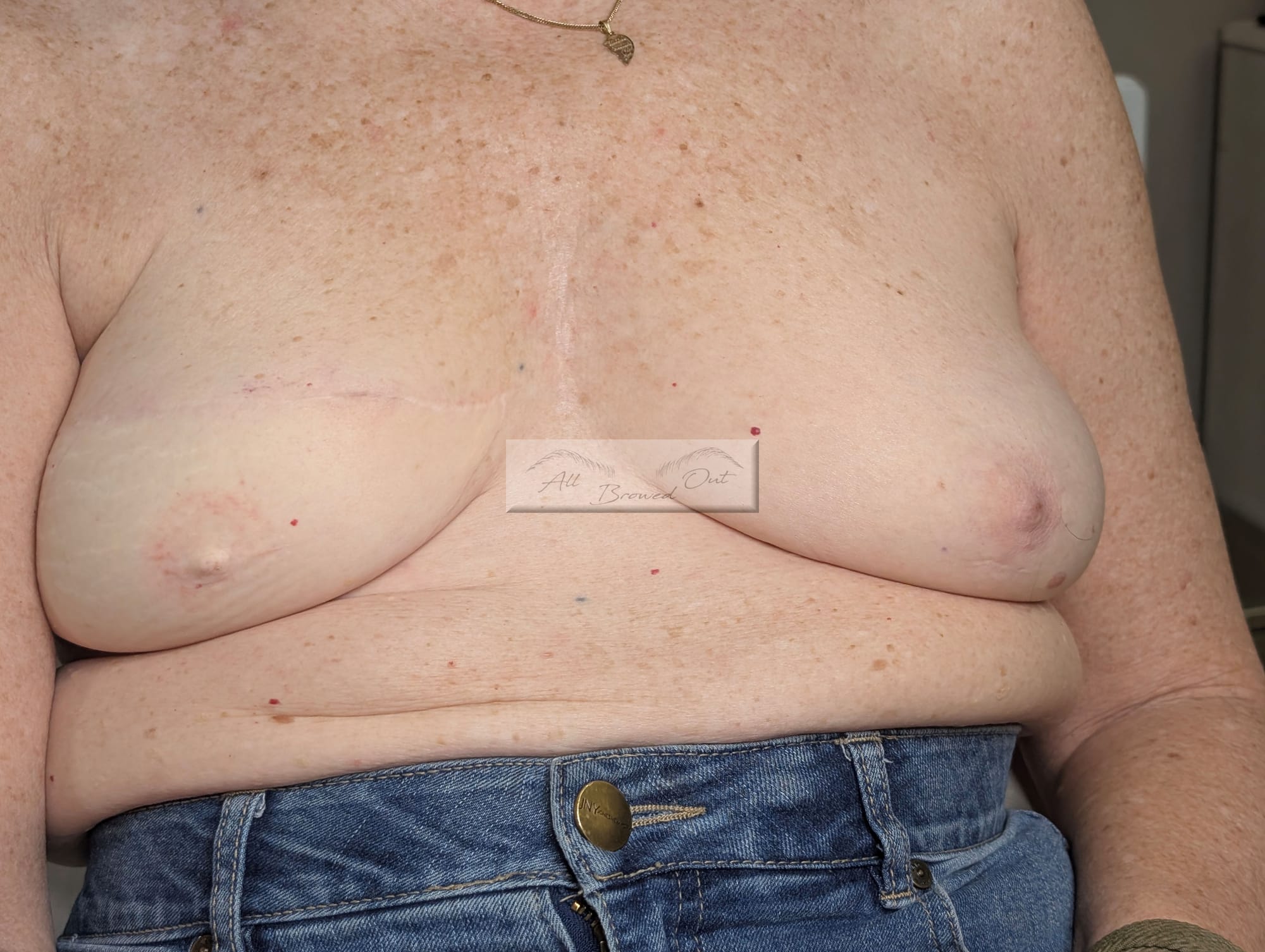 BREAST CANCER SURVIVOR UNILATERAL BEFORE