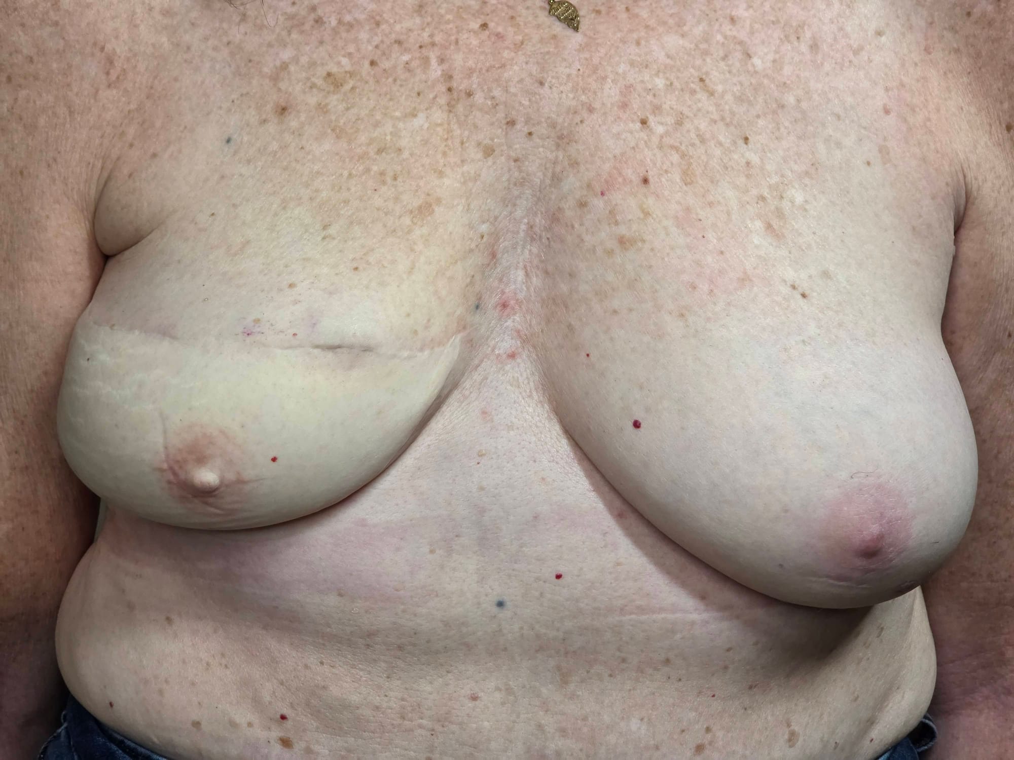 BREAST CANCER SURVIVOR UNILATERAL RIGHT, 8 WEEKS HEALED