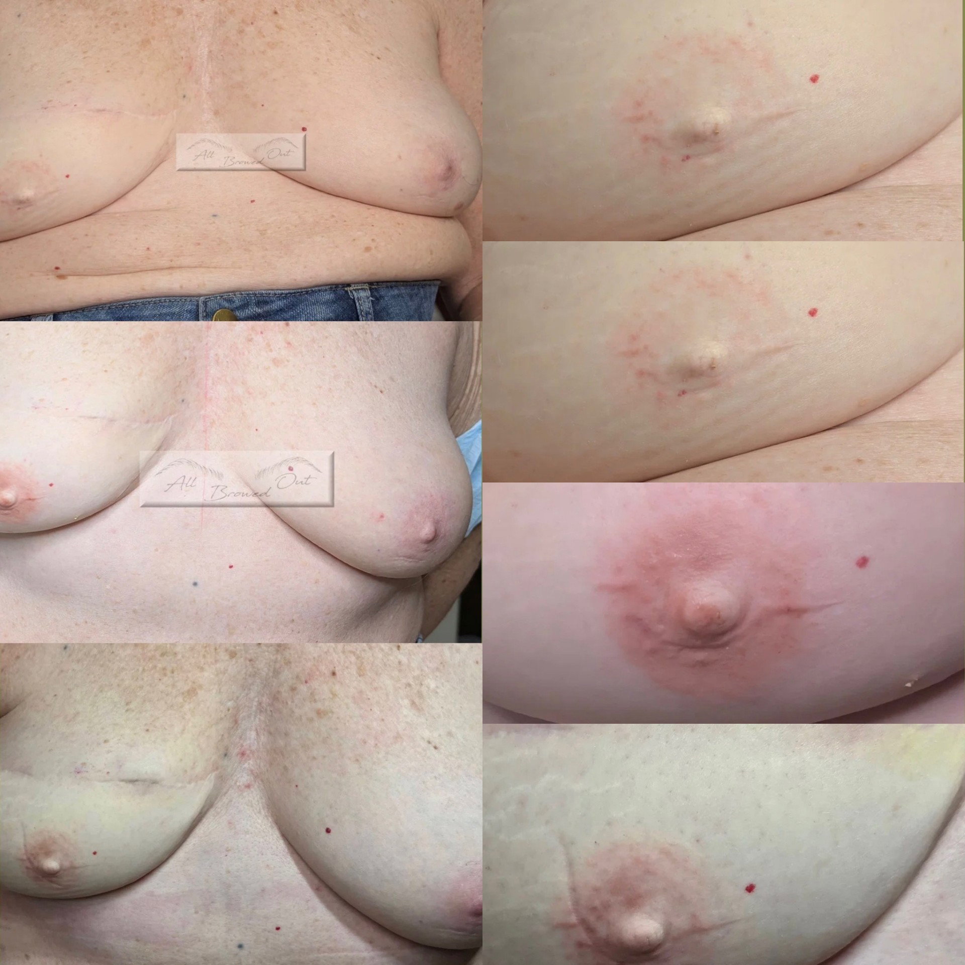 Unilateral 3D Areola Restoration