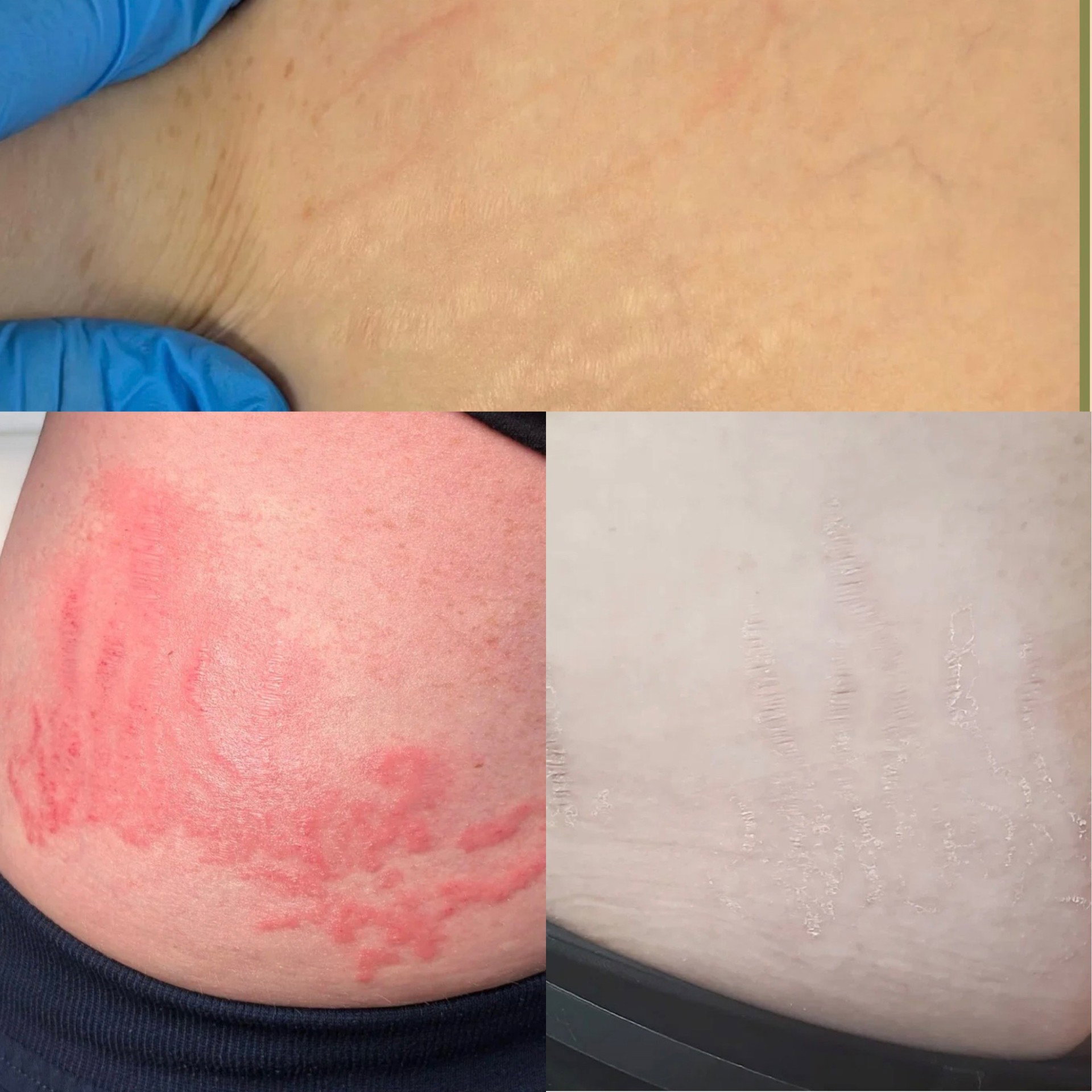 Inkless Stretch Mark Revision