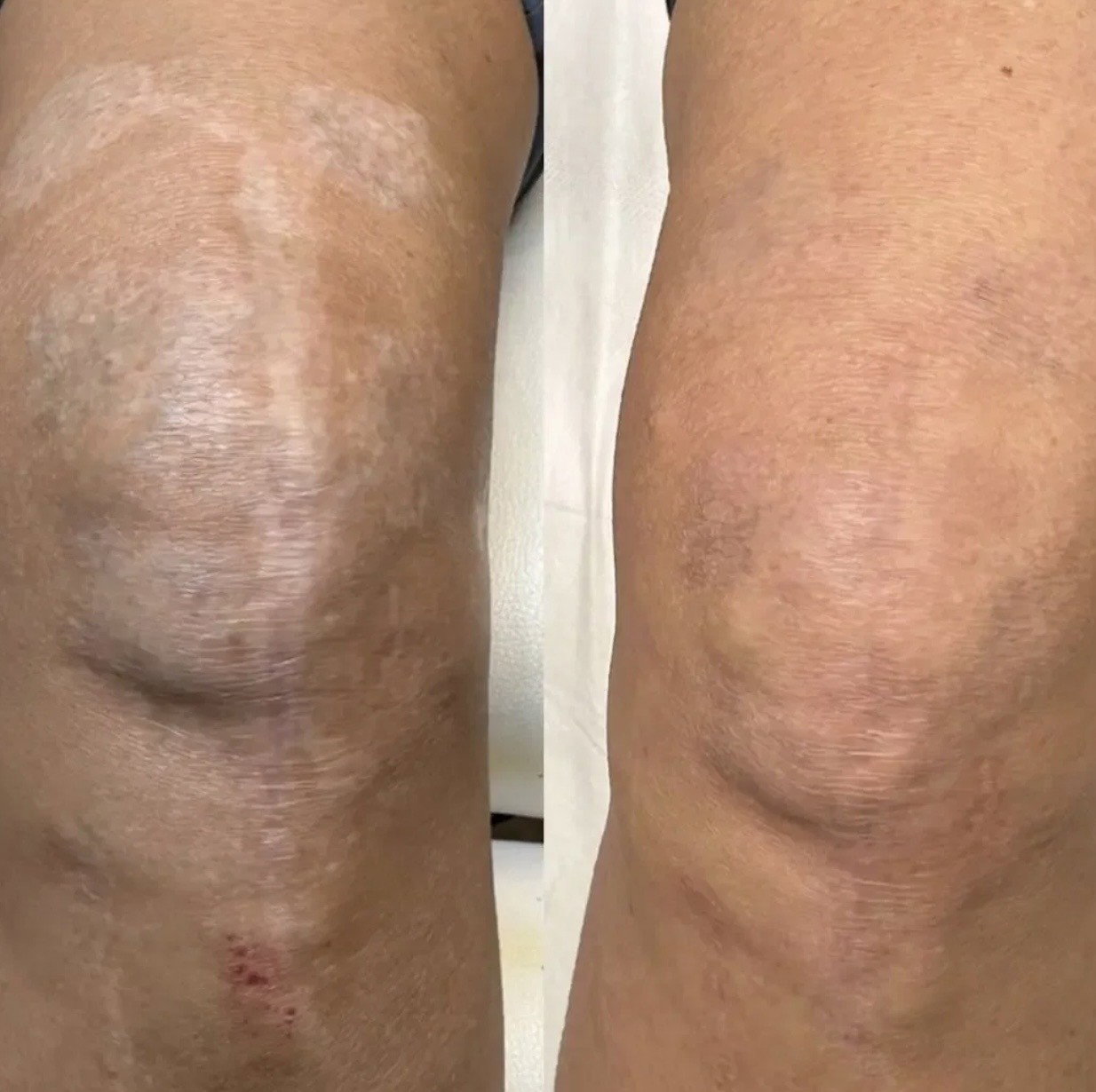 Inkless Scar Revision and Camouflage