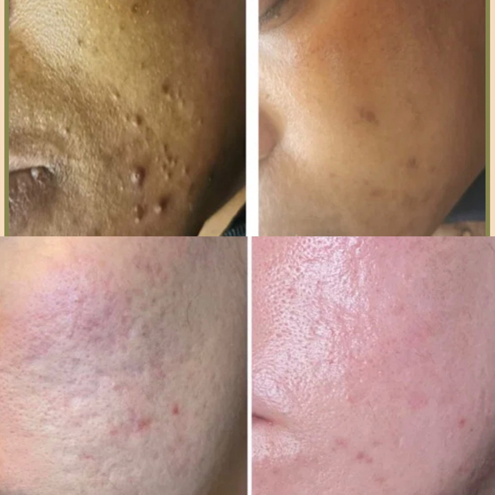 SQT Bio Microneedling