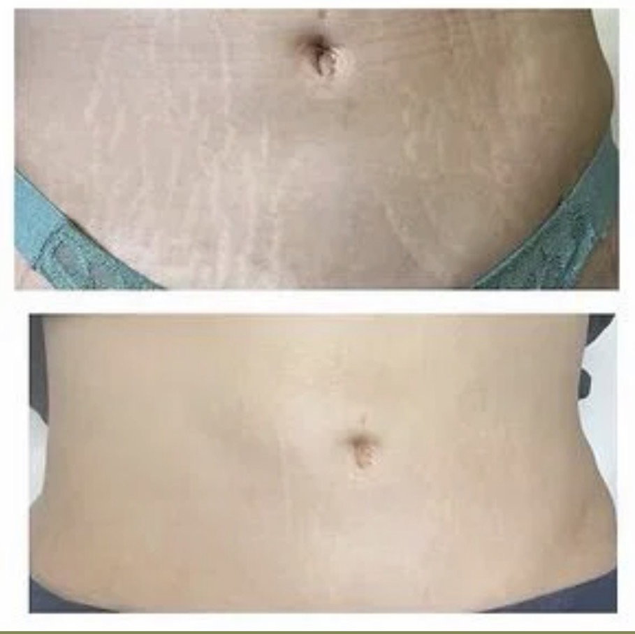 Camouflage Tattoo Procedure
