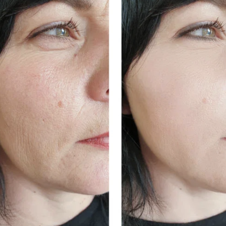 Microneedling Before & After