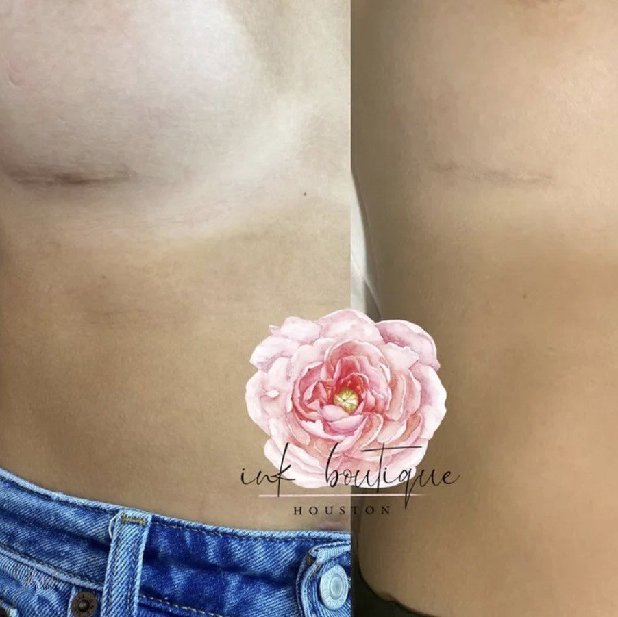 INKLESS SCAR REVISION UNDER BREAST