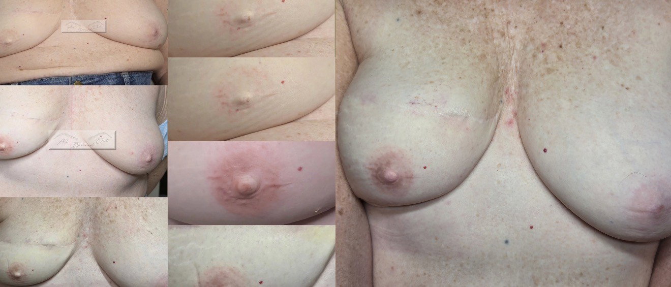 Unilateral 3D Areola Restoration