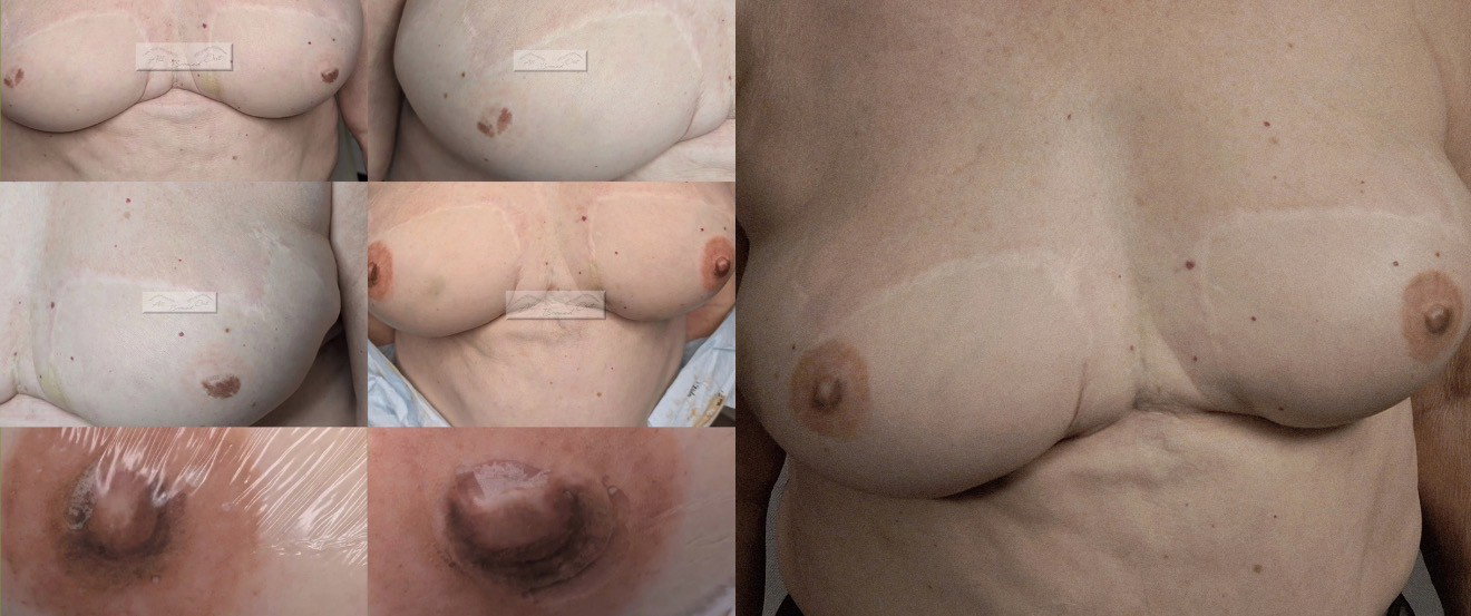 Bilateral 3D Areola Restoration