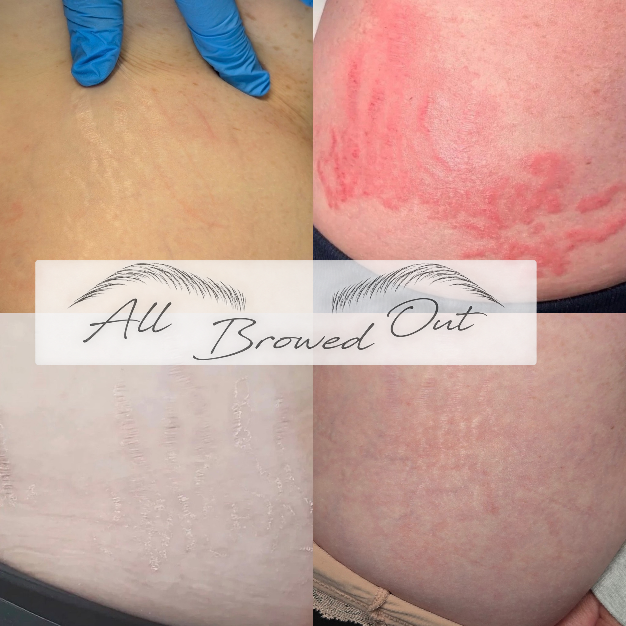 Inkless Stretch Mark revision