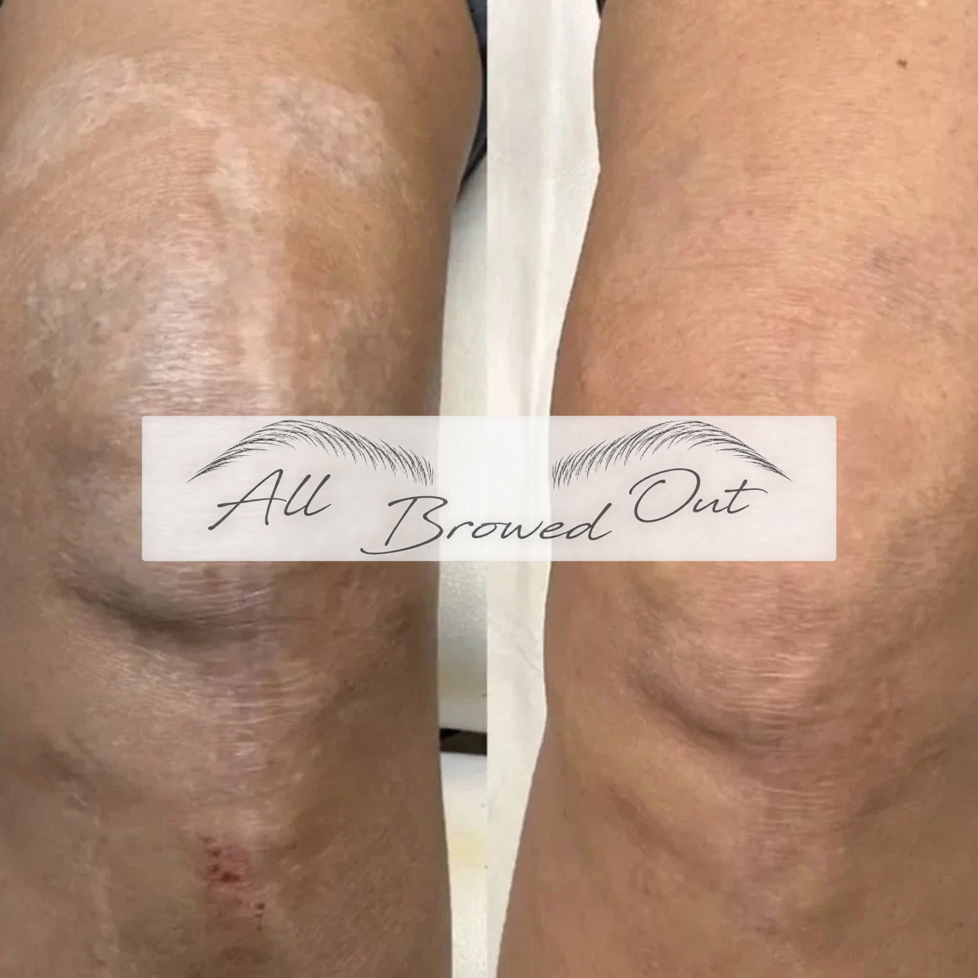 Inkless Scar Revision and Camouflage