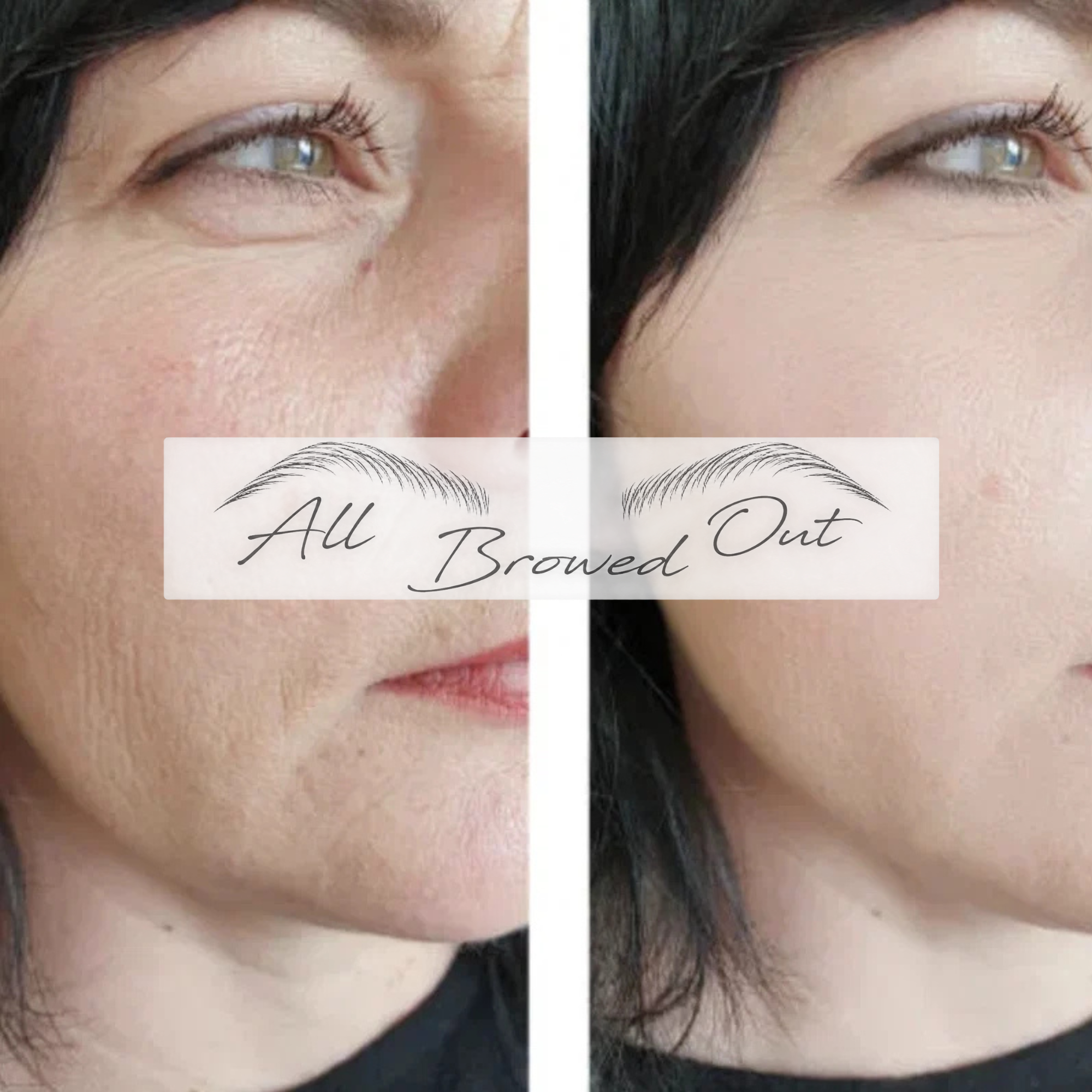Microneedling Before & After