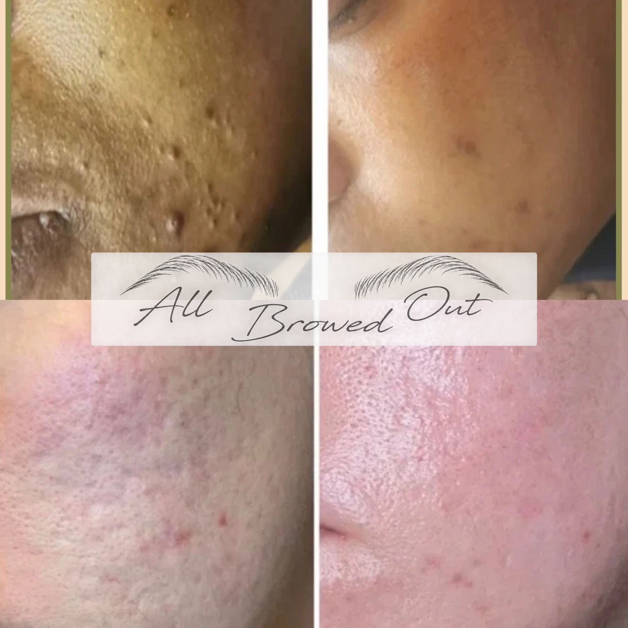 SQT Bio Microneedling