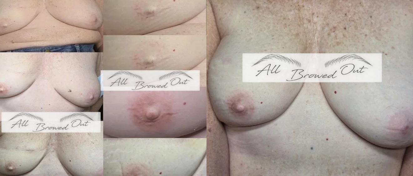 Unilateral 3D Areola Restoration