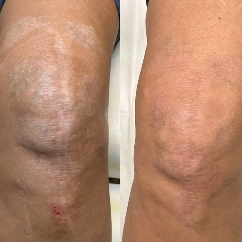 Scar/Stretch Mark Camouflage Tattoo