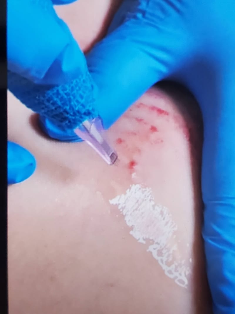 Inkless Scar/Stretch Mark revision