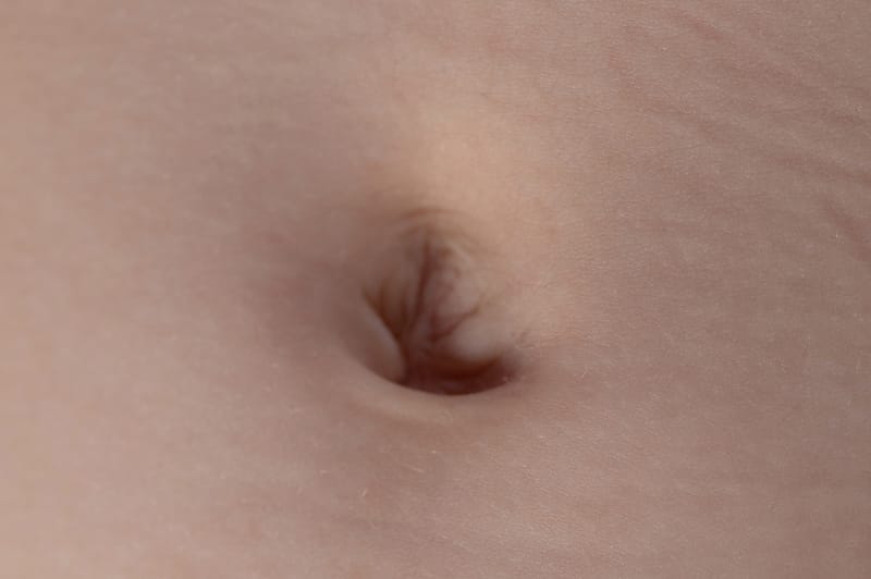3D Belly Button Restoration