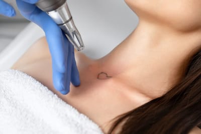 Why Is Multiple Laser Sessions Needed for Tattoo Removal?