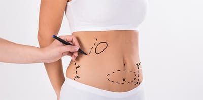 Can liposuction enhance overall body proportion?