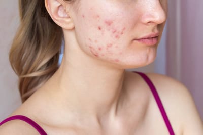 Can Stress Reduction Improve Pimples and Acne?