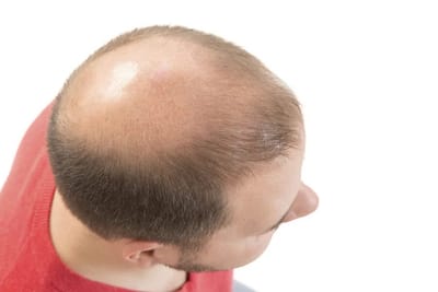 How does crown hair transplant improve hair growth?