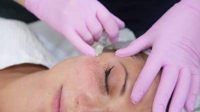 What Skin Concerns Can a Vampire Facial Treat?
