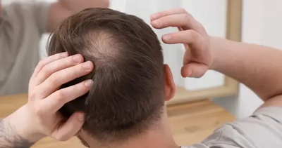 Why is crown hair transplant popular among men today?