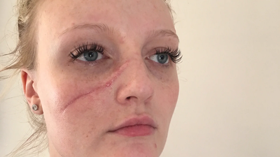 Why Can Scar Removal Treatments Cause Redness?