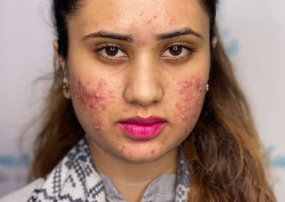 Do Pimples Treatments Help With Oily Skin Too?