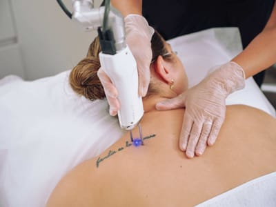 Does laser tattoo removal work on all skin types?