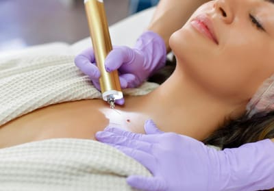 What Is the Role of Dermatologists in Mole Removal?