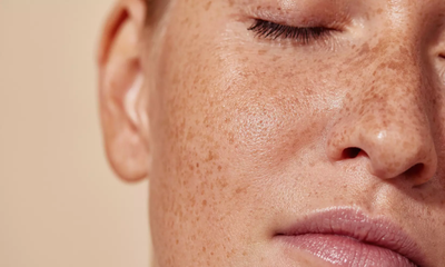 What role does hydration play in melasma treatment?