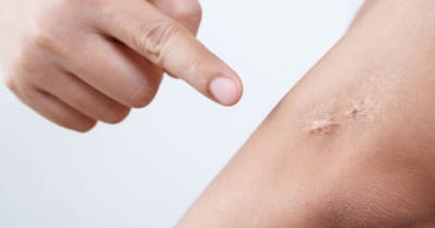 Do Keloid Scars Impact Skin Flexibility or Texture?