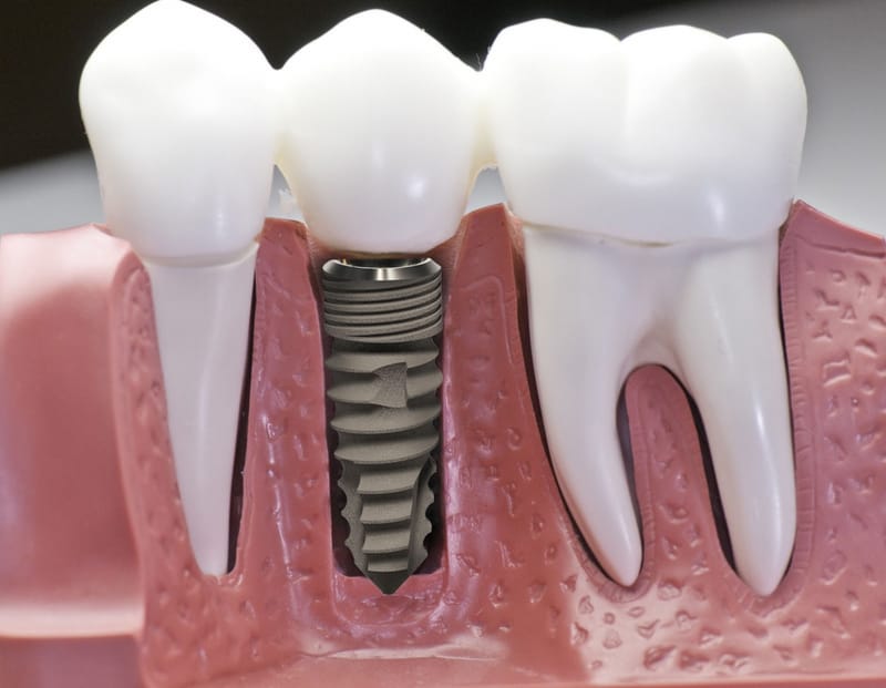 Restore Your Smile with World-Class Implants