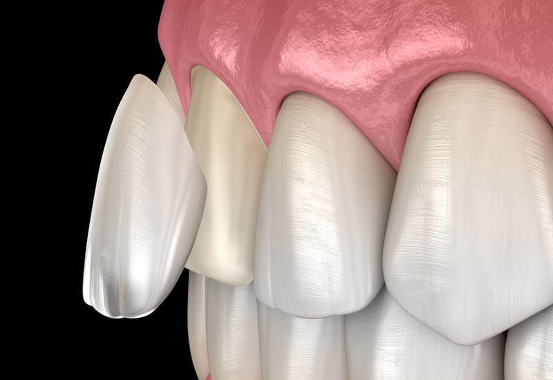 Porcelain Veneers - Aesthetics with Minimal Intervention