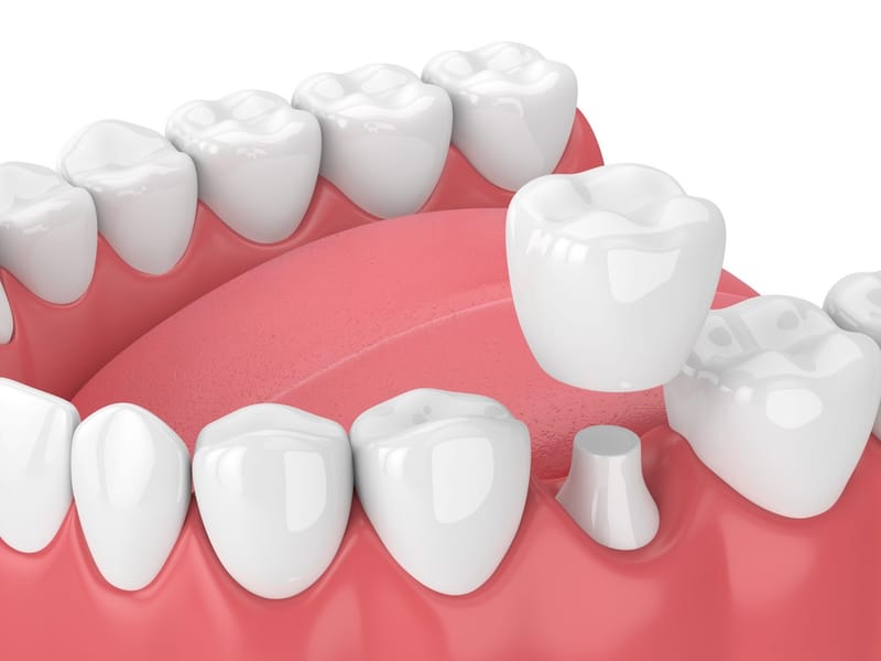 Journey to Rediscover Your Confident Smile