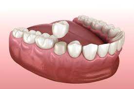 Aesthetic & Durable Porcelain Crown Restoration