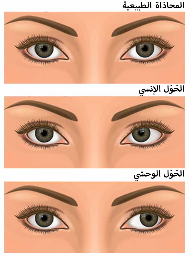 فحص حالات الحول