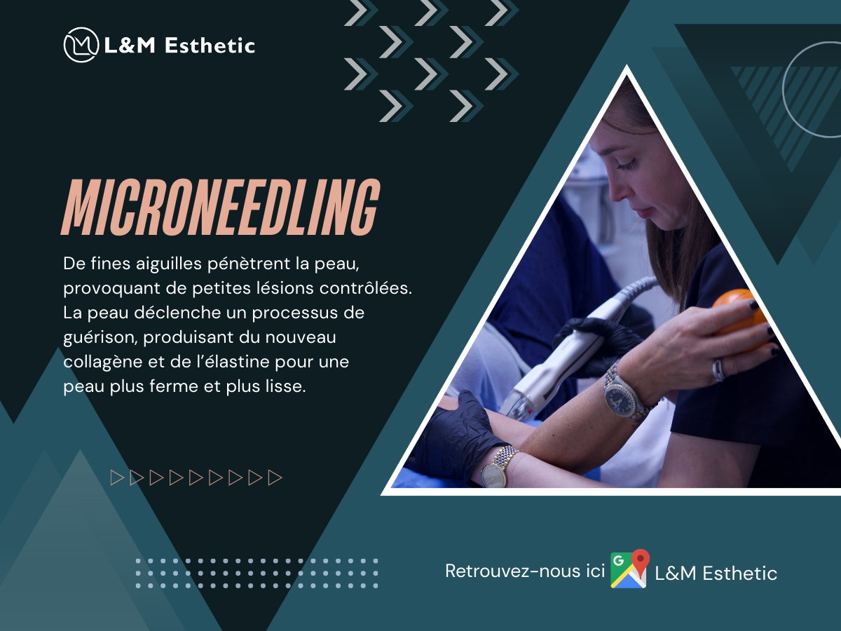 Microneedling