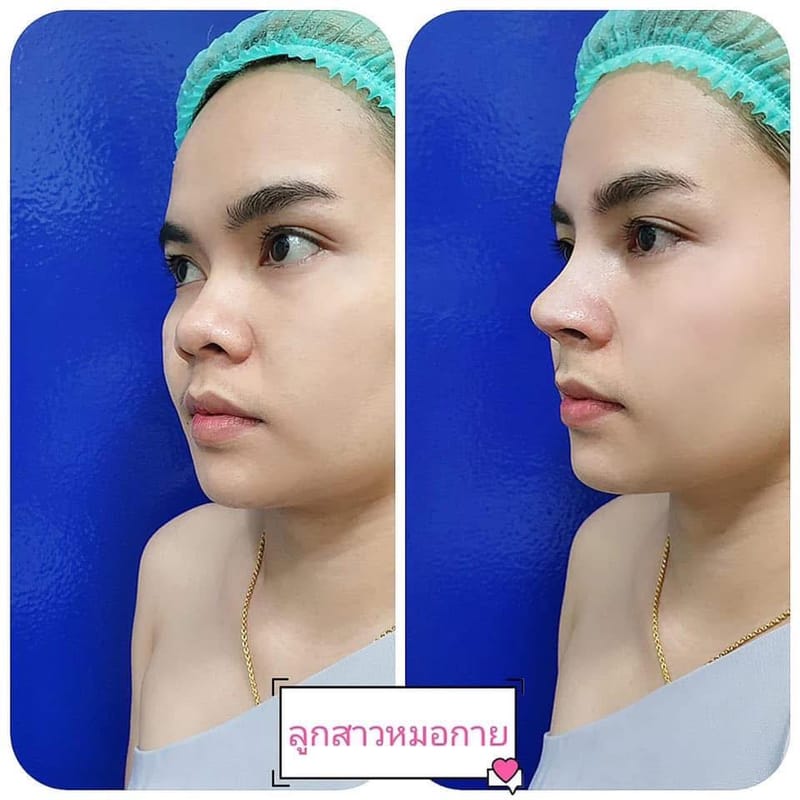 เสริมจมูก-แก้จมูก