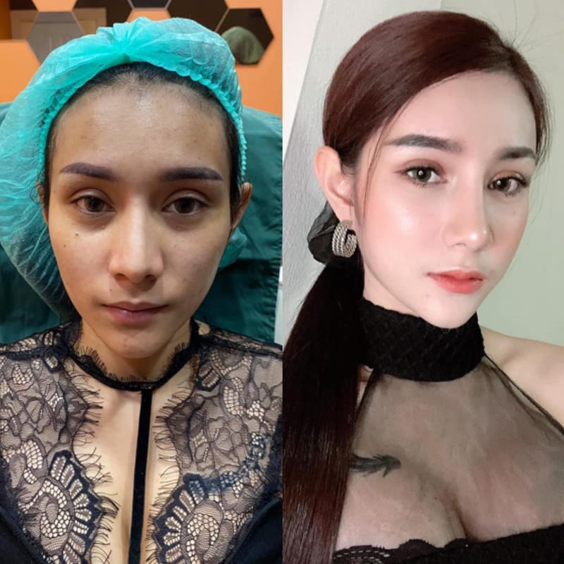 ปรับเปลี่ยนรูปหน้าด้วยฟิลเลอร์